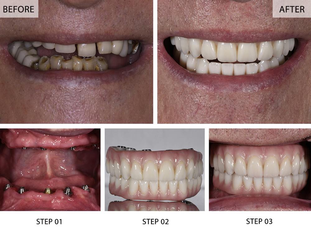 Real patient full mouth reconstruction: before and after smile, implants in the jaw, zirconia arches outside the mouth, and the final fixed result